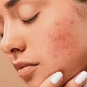 COSMETICS INDUCED PIMPLES (ACNE)