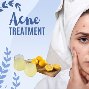 WHY SHOULD LIMONENE BE USED FOR ACNE TREATMENT?
 
