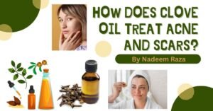 HOW DOES CLOVE OIL TREAT ACNE AND SCARS?