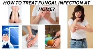 HOW TO TREAT FUNGAL INFECTION AT HOME?