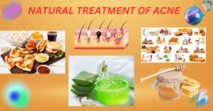 NATURAL TREATMENT OF ACNE