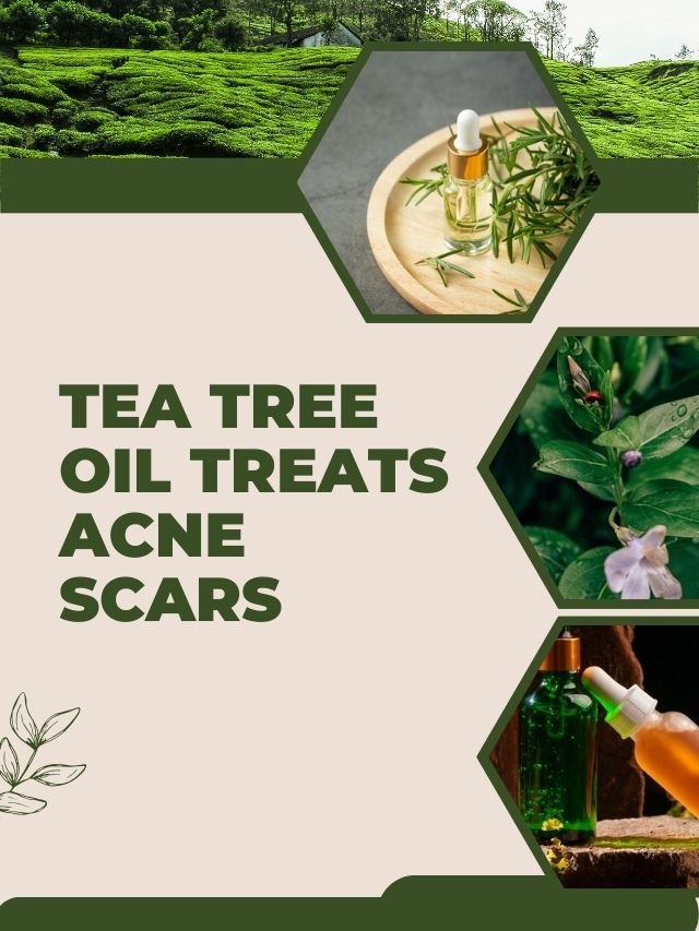 TEA TREE OIL TREATS ACNE SCARS